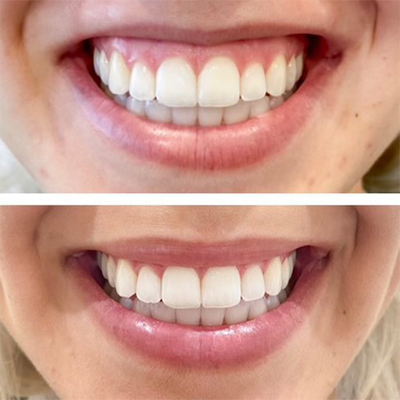 R+H BOTOX Patient Before and After: Gummy Smile and Lip Flip
