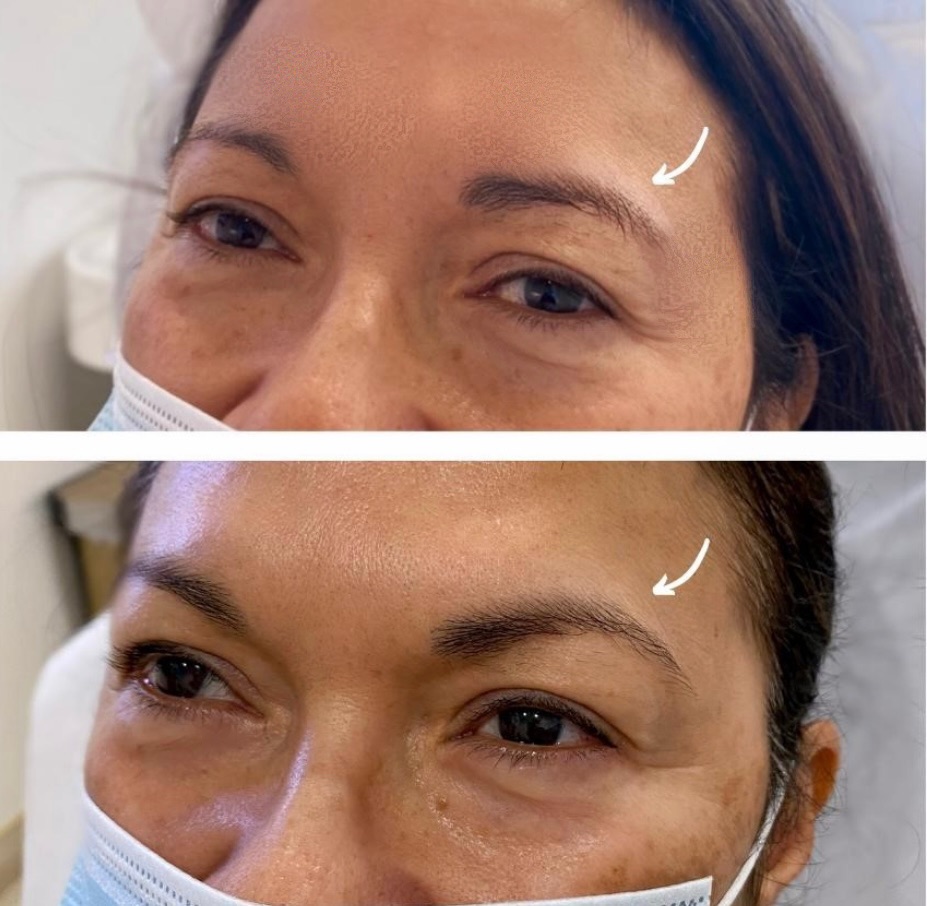 R+H BOTOX Patient Before and After: Brow Lift
