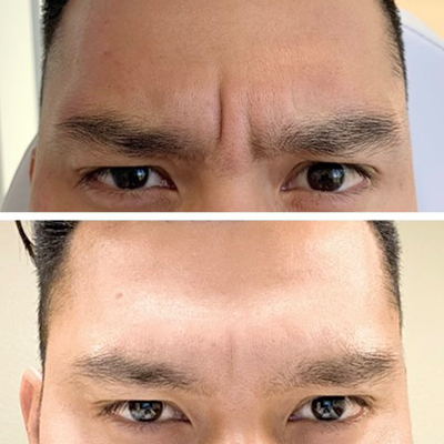 R+H BOTOX Patient Before and After: Frown Lines