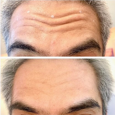 R+H BOTOX Patient Before and After: Forehead