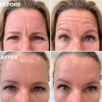 R+H BOTOX Patient Before and After: Frown Lines and Forehead