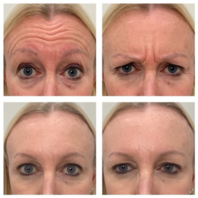 R+H BOTOX Patient Before and After: Frown Lines and  Forehead