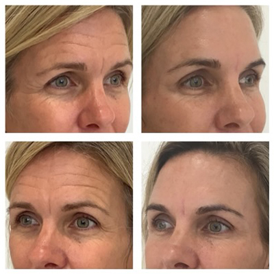 R+H BOTOX Patient Before and After: Frown Lines, Forehead, Crow’s Feet