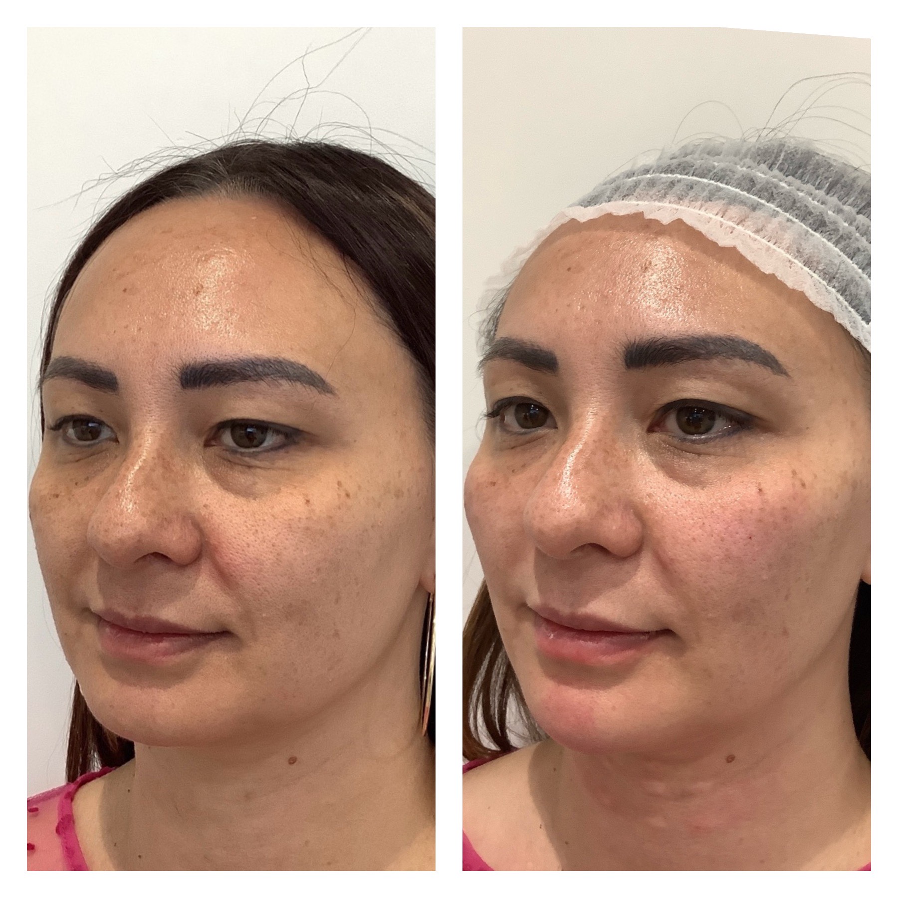 R+H BOTOX Patient Before and After: Frown Lines and Forehead