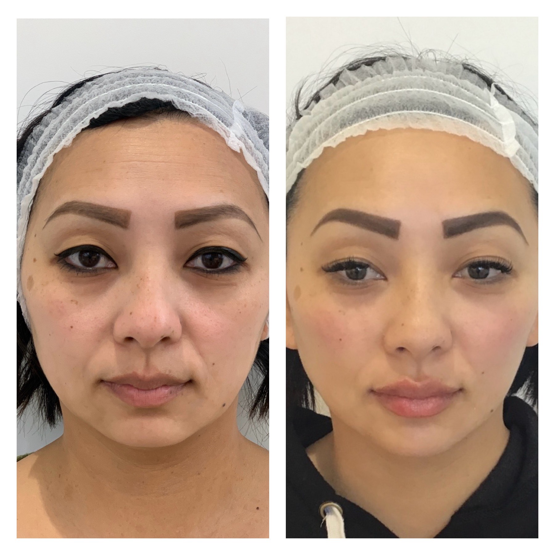 R+H BOTOX Patient Before and After: Frown Lines and Forehead